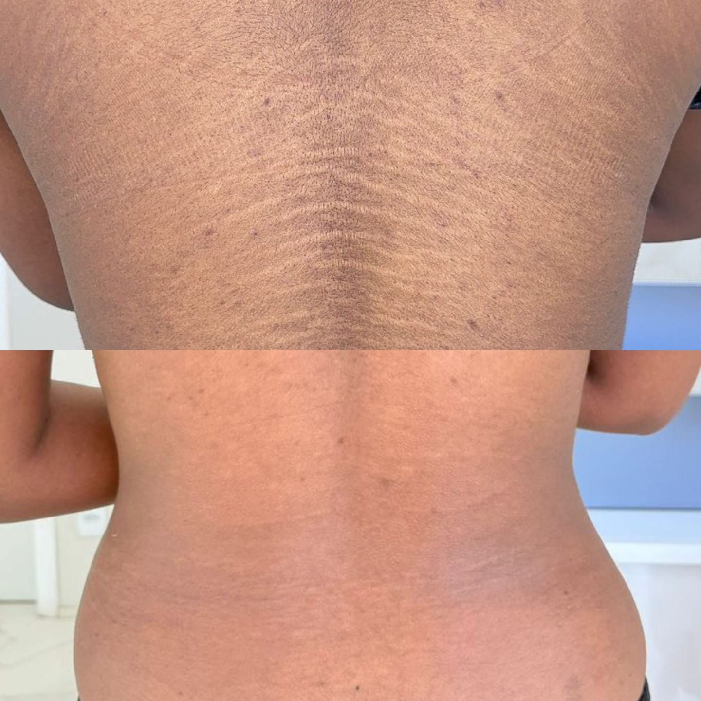 Estrias brancas têm tratamento? Especialistas explicam