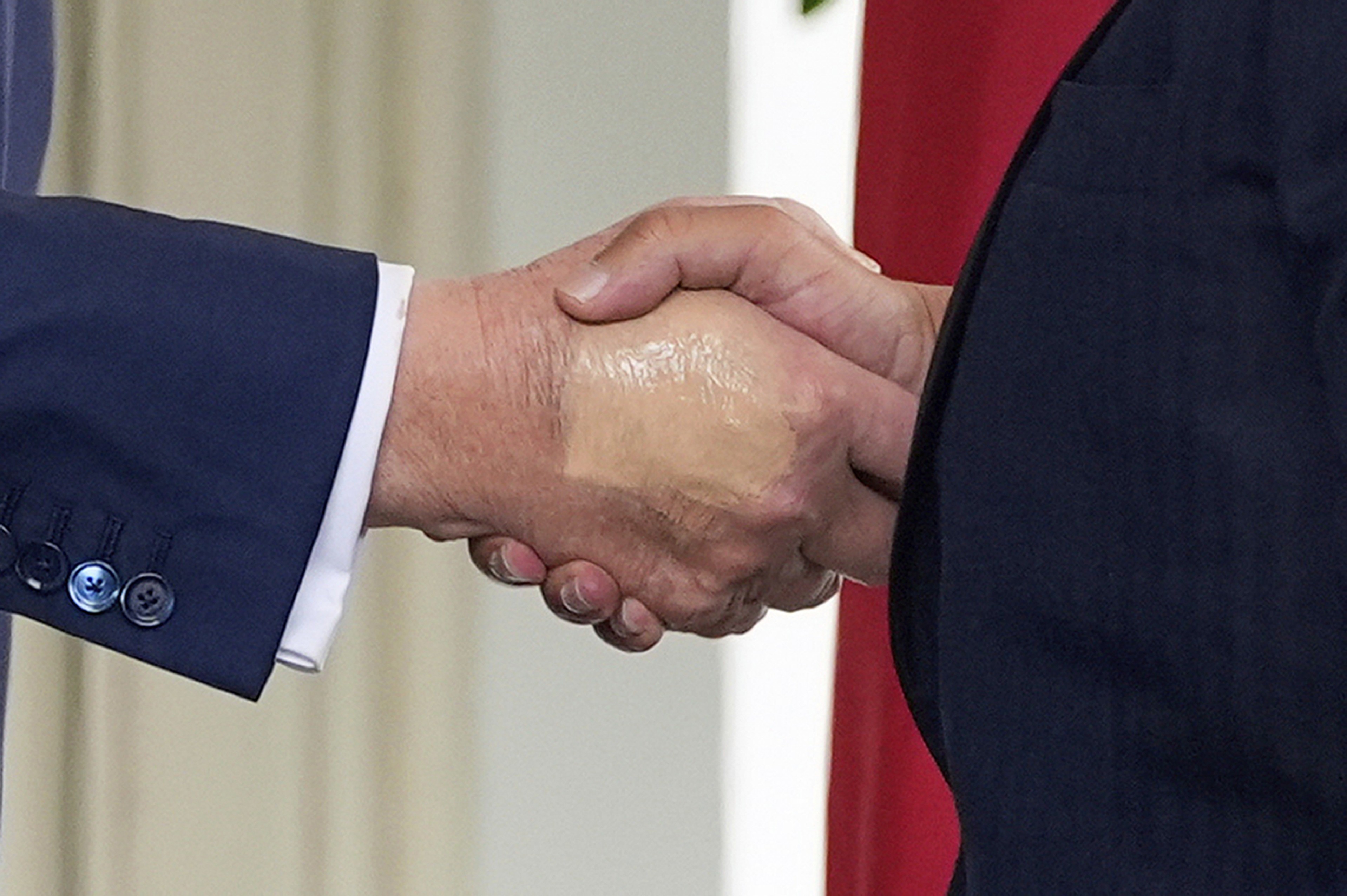 Trump foi flagrado com mão maquiada e pés inchados antes de diagnóstico de insuficiência venosa crônica; VEJA FOTOS